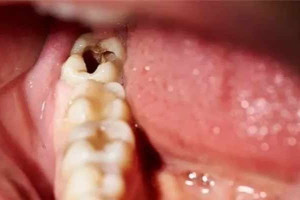 பல் சொத்தைப்  வராமல் தடுப்பது எப்படி?.