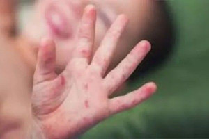 இலங்கையில் மீண்டும் தலைதூக்கும் தட்டம்மை - சுகாதாரத் துறையினர் எச்சரிக்கை