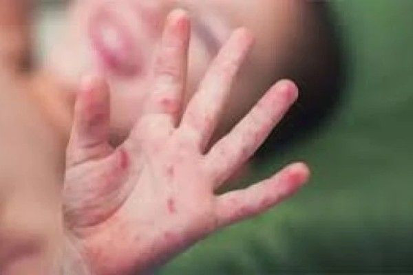 இலங்கையில் மீண்டும் தலைதூக்கும் தட்டம்மை - சுகாதாரத் துறையினர் எச்சரிக்கை