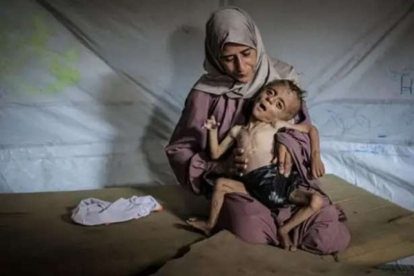 காசாவில்கடும் பட்டினியின் பிடியில் சிக்குண்டுள்ள சிறுவனின் புகைப்படம் சொல்லும் கதை