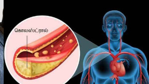 அதிக கொலஸ்ட்ரால் இருப்பதை காட்டும் அறிகுறிகள் என்ன?