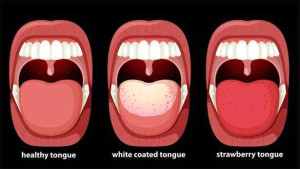 நாக்கின் நிறம் சொல்லும்  உடல் ஆரோக்கியம் பற்றி தெரியுமா ?