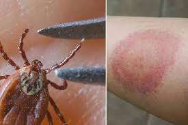 ஒன்றாரியோவில் உண்ணிகள் பரவும் நோய்த் தொற்று