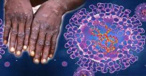 தென்னாப்பிரிக்காவில் Monkeypox  வைரஸால் பலியாகிய இரண்டாவது நபர்