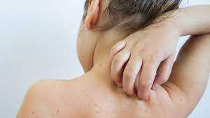 கனடாவில் தட்டம்மை நோய் தொடர்பில் விடுக்கப்பட்டுள்ள எச்சரிக்கை