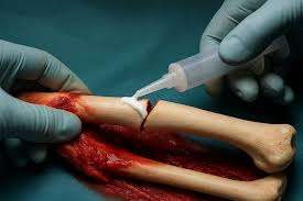 எலும்பு முறிவை 3 நிமிடத்தில் சரி செய்துவிடலாம் - சீன விஞ்ஞானிகளின் புதிய கண்டுபிடிப்பு