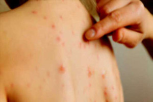 சிலமதக் காரணங்களினால் ஒன்றாரியோவில் தட்டம்மை நோய் பரவுகிறது – டக் ஃபோர்ட்