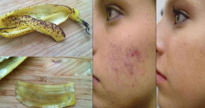 முகப்பரு பிரச்சனைக்கு தீர்வு தரும் வாழைப்பழத்தோல்